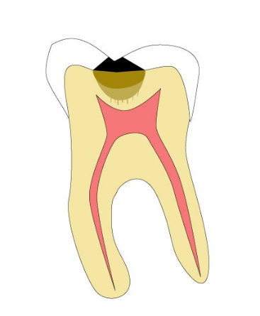 虫歯の構造