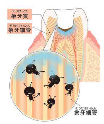 象牙細管の虫歯イメージ